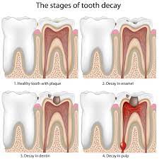 Fluoride Varnish Dental Treatments In Dallas Texas Privia