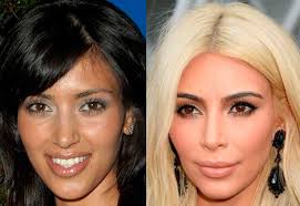 And while the victoria's secret model, 22, remains adamant she is au naturel, professional cosmetic surgeons have some doubts looking at her before and after pictures. Kim Kardashian Plastic Surgery London