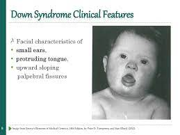 Chromosome Abnormalities Ppt Download