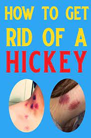 9781794076266: How To Get Rid Of A Hickey: 39 Natural Remedies To Get Rid  Of A Hickey Fast - Abebooks - Nova, Booki: 1794076263