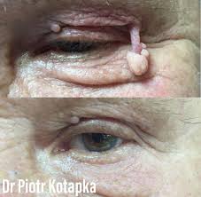 Laserowe usuwanie znamion i brodawek. Usuwanie pieprzyków | Klinika  Medycyny Estetycznej i Laseroterapii Tesoro Clinic