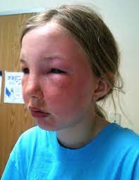 How to select & use. Sunscreen Allergy