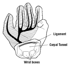 Carpal Tunnel Syndrome Osh Answers