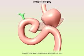 Gastroenterology Education And Cpd For Trainees And Specialists Whipple S Operation