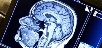 Brain Chemical Aids Tic Control In Tourette Syndrome Say Researchers