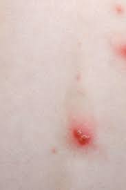Ibc does not usually cause lumps to form in breast tissue. Chickenpox Symptoms Treatment Stages And Causes