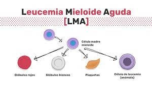 La leucemia mieloide aguda (lma) es un tipo de cáncer de la médula ósea causado por una alteración en la maduración y proliferación de las células madre de la médula ósea que producen las células de la sangre. Tipos De Leucemia Mieloide Aguda Youtube