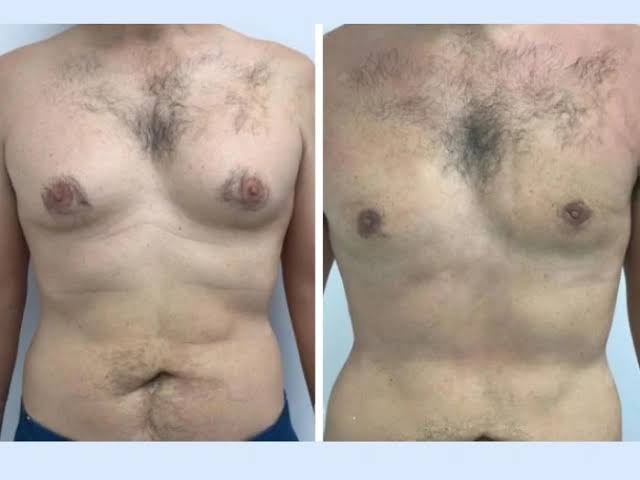 Gynecomastia in Dubai: What First-Time Patients Often Want to Know