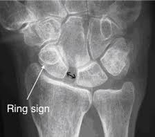 Image result for Scapholunate Dislocation