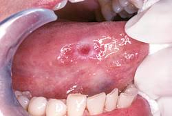 For clues about problems in your mouth, stick out your tongue and. Oral Cancer Diagnosis Treatment Ottawa Il