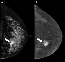 Image result for Mammogram Interpretation