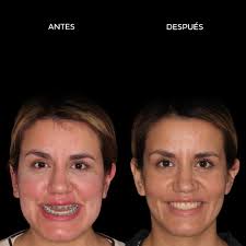 Cirugía Ortognática Mínimamente Invasiva⁣⁣⁣⁣⁣⁣ ⁣⁣⁣⁣ 👩🏻‍⚕️⁣ Ortodoncia a  cargo de Dra. Laura Andrada (@dralauraandrada)⁣⁣⁣⁣ ⁣⁣ 🦷 La paciente sufría  una deformidad dentofacial, que fue corregida exitosamente a través de un  triple procedimiento