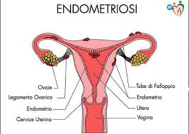 La conseguenza di questa sintomatologia variegata. L Endometriosi E L Osteopatia Physiolife Velletri