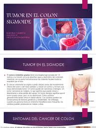 Explanation for the 'colon sigmoide' phrase in the phrases.com dictionary. Tumor En El Colon Sigmoide1 Cancer Colonrectal Sistema Digestivo