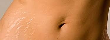 Cilt Catlaklarini Gecirmenin Etkili 10 Dogal Yolu Cilt Sitesi Stretch Marks Microneedling Stretch Mark Remedies