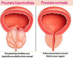 Operatie prostata pret forum 2018. Prostatita Cronica Cauze Simptome Tratament