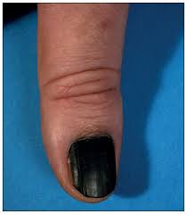 Image result for Acral lentiginous melanoma nail