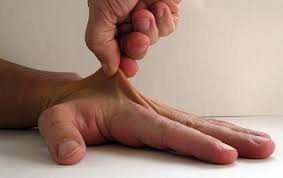 Raynaud's syndrome (also called raynaud's phenomenon) is a what are raynaud's syndrome risk factors? Ehlers Danlos Syndrom Eds Bindevevssykdommer Nobindevevssykdommer No