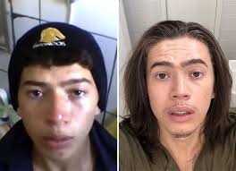 Especialista em harmonização facial, a dra. Whindersson Nunes Faz Desafio Dos 10 Anos E Brinca Pensei Que Ia Ter Barba De Lenhador Quem Quem News