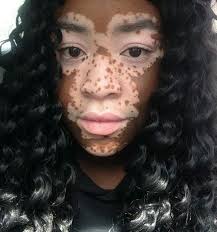 Black And White Skin Condition Model Pin By Tara On Beauty Marks Vitiligo Treatment Vitiligo Model Vitiligo