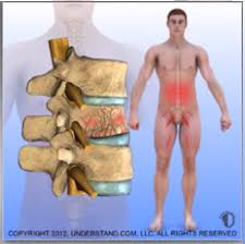 Image result for Vertebral Compression Fracture