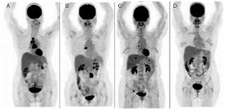 For a ct scan to work properly, you have to stay really, really still like you do when you play. Staging Recurrent Ovarian Cancer With 18fdg Pet Ct