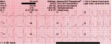 Image result for Sodium Channel Blocker