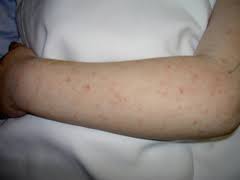 Raw apple cider vinegar or acv is an excellent home remedy to calm down the itching on red spots in petechiae and treats skin rashes too. Purpura Wikem