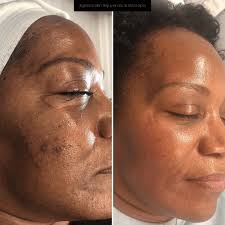 Image result for Laser Skin Procedure