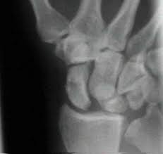 Image result for Scaphoid Shift Test