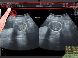 Jika bayi anda perempuan, ovarium mulai menghasilkan jutaan sel telur pada minggu ini. Cara Membaca Foto Usg 8 Langkah Dengan Gambar Wikihow