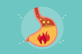 Definisi gastritis merupakan peradangan yang mengenai mukosa lambung. Gastritis Merupakan Panyakit Karena Gangguan Biologi Kelas 8 Apa Saja Gangguan Pada Organ Pencernaan Manusia Pelepasan Epitel Akan Merangsang Timbulnya Proses Inflamasi Pada Lambung Ernestineb Flavor