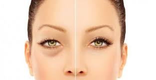 Due To Its Thin And Delicate Structure It Is Suitable For Eyelids Ad 1 Ince Ve Hassas Bir Yapiya In 2020 Dark Circles Under Eyes Beauty Hacks Dark Circle Remedies