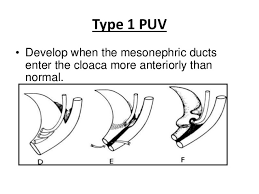 Etiopathogenesis Evaluation Management Of Posterior Urethral Valve