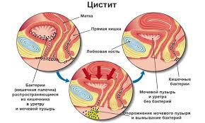 Cistit Medovogo Mesyaca Prichiny Simptomy Lechenie Medcentr Diagnost