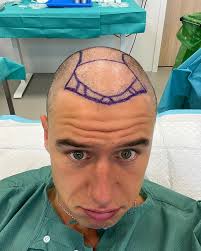 Over the last 10 years, I've been really struggling with my hair thinning.  Let me start with that is not sponsored. I've paid the full amount and I'm  sharing this for me