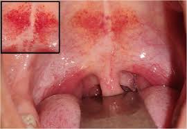 Image result for Strep throat infection roof of mouth