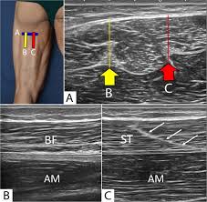 Both tendons and ligaments are dense regular connective tissue, because of its two properties: Sonographic Landmarks In Hamstring Muscles Springerlink
