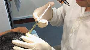 Prp malaysia | how much does it cost for prp treatment in malaysia. Platelet Rich Plasma Prp Peter Ch Ng Skin Specialist Kl Malaysia