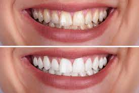 El Paso Dentists Want To Remove Your Teeth Stains | El Paso, TX