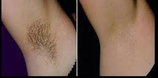 We give you a written price for the hair removal service that best fits your needs and we have no hidden fees. Best Laser Hair Removal Toronto Laser Hair Removal Laser Hair Laser Hair Removal Face