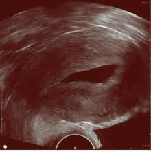 This imaging test uses sound waves to detect the abnormal veins. Gynecologic Ultrasonography Wikipedia