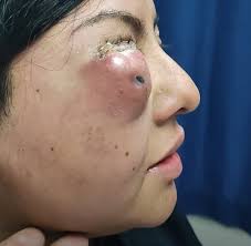 Granos Y Espinillas Gigantes