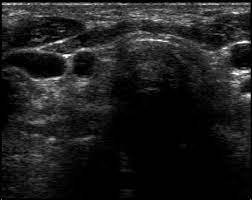 Check spelling or type a new query. The Role Of Ultrasound In The Differential Diagnosis Of Hypothyroidism Intechopen