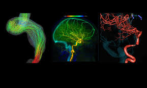 Tinnitus is a symptom suggestive of some underlying disorder. Pulsatile Tinnitus Causes And Treatments Ucsf Radiology