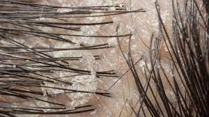 Masalah kulit psoriasis seperti ketombe? Kulit Kepala Gatal Dan Bersisik Waspada Penyakit Dermatitis Seboroik