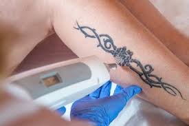 Tattoo removal clinic is held once a month on a saturday. Cosmetic Procedures Tattoo Removal Nhs