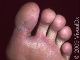 Image result for Pitting nails feet