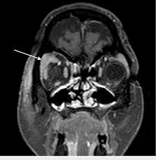 Image result for Dacryoadenitis