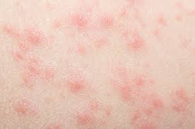Penyebab paling umum dari bintik merah pada kulit disertai gatal berikutnya adalah dermatitis kontak. Ini Jenis Jenis Ruam Kulit Pada Orang Dewasa